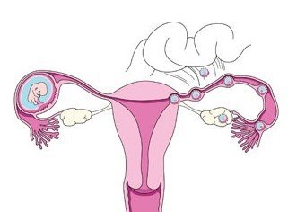 怎么才能查出子宫内膜异位症
